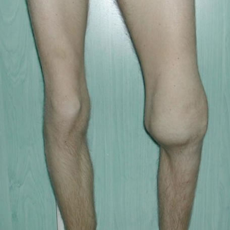 arthrosis